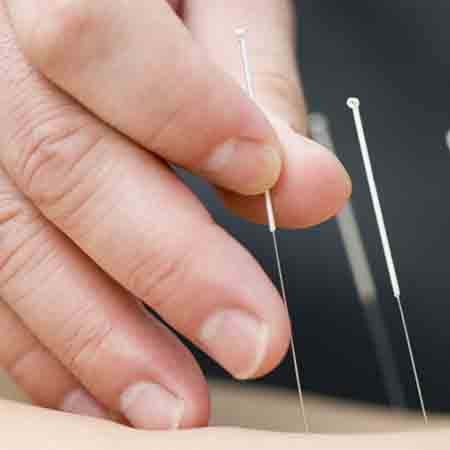 Acupuncture Needle (25X75) 3 (100pc) एक्यूपंक्चर नीडल 3" (25X75) 100 पीस AC-1116